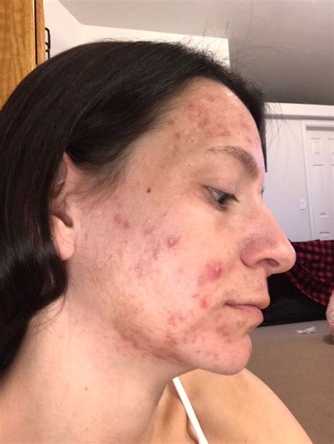 Review by carey C. | Musely The Spot Cream Reviews