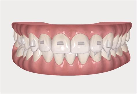Image result for Invisalign ClinCheck