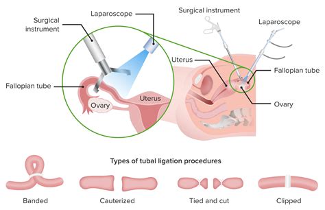 Anticonceptivos no Hormonales | Concise Medical Knowledge