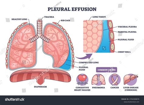 Pleural Effusion Diagram Depicts Fluid Pleural Stock Vector (Royalty Free) 2704399879 | Shutterstock