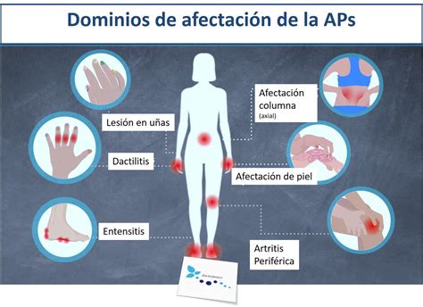 Recomendaciones en el manejo de la Artritis Psoriasica - Clínica ...