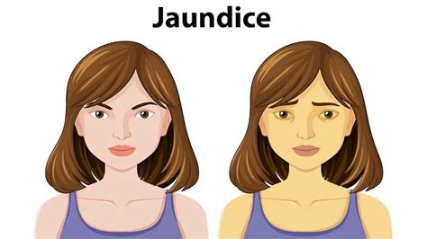 Can Jaundice Cause Dehydration at Hector Dwight blog