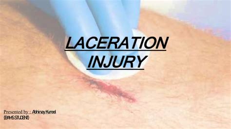 LACERATION INJURY | PPT | PPTX