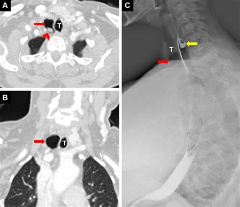 A Case Report of an Adult With Coexistence of Tracheal and Esophageal Diverticulum | Archivos de ...