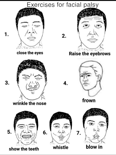 Exercises for Facial Palsy /Bell’s Palsy– Improve Facial Movement