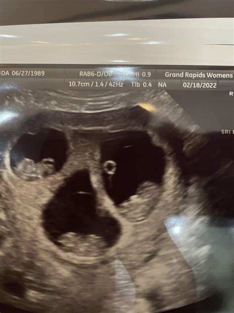 9 Week Ultrasound Identical Twins