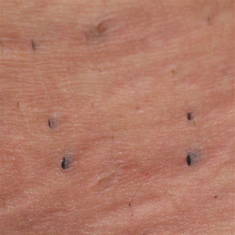 Boils On Inner Thigh Women