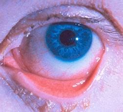 Conjunctivitis - American Association for Pediatric Ophthalmology and ...
