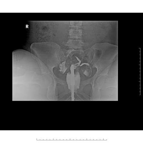Uterus Didelphys Pictures