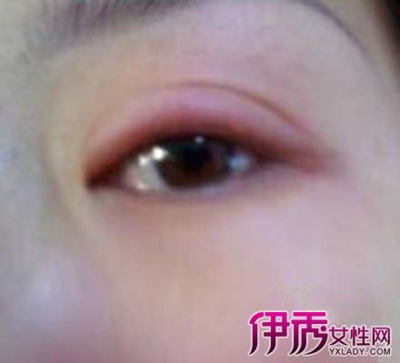 眼睛儿童过敏和结膜炎红色过敏，充血的健康 库存图片. 图片 包括有 健康, 炎症, 激怒, 干草, 疾病 - 142421711