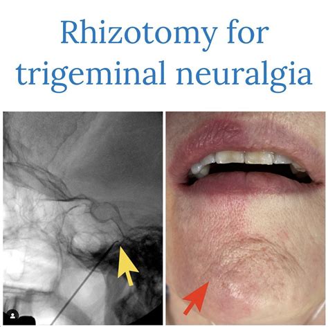 Trigeminal Neuralgia Treatment