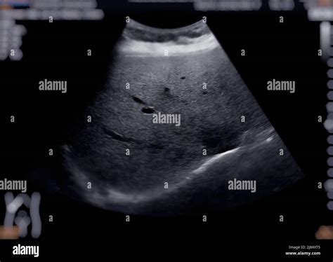 Hepatic liver ultrasound showing hi-res stock photography and images - Alamy