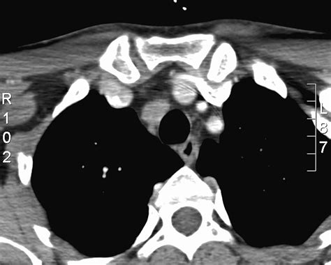 Paratracheal Lymph Nodes In Lungs