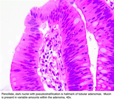 Pathology Outlines - Tubular adenoma