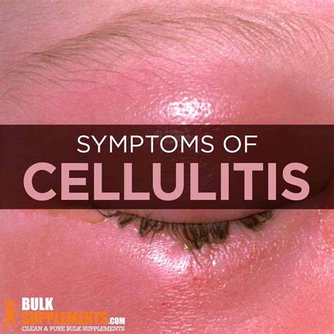 Cellulitis. Effective Treatment & Supplement Solutions For You