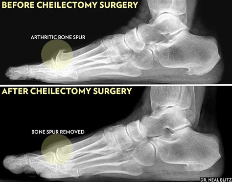 Cheilectomy: Big Toe Bone Spur Surgery and Recovery