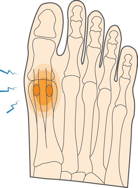 Common Causes of Big Toe Joint Pain - The Foot Clinic | Cottesloe