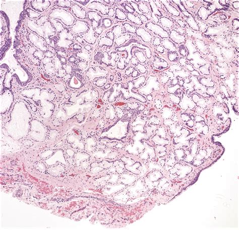 Vestibular Gland Cyst