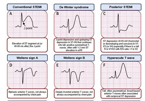 Image result for STEMI Algorithm