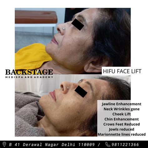 HIFU Treatment Non Surgical Facelift | Dr Geeta Arora | Backstage Delhi