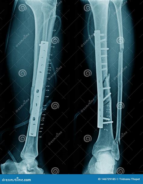 Fracture tibia bone stock image. Image of disease, broken - 146729185