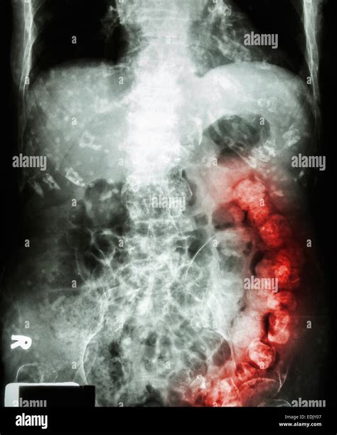 Full Stomach X Ray