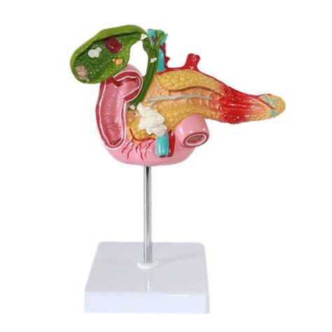Buy Pancreas Duodenum Gallblasse Hydrops Model, Vessels Nerves, Liver ...