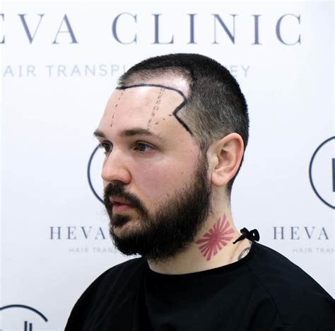 Minoxidil (Rogaine) Before and After Hair Transplant - Should You Use?