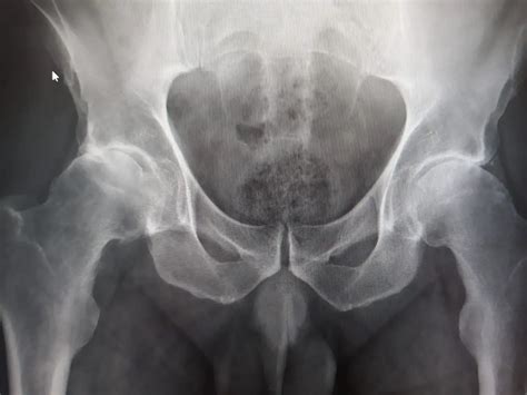 Enfermedad Articular De Cadera - eFISIO Fisioterapia Madrid