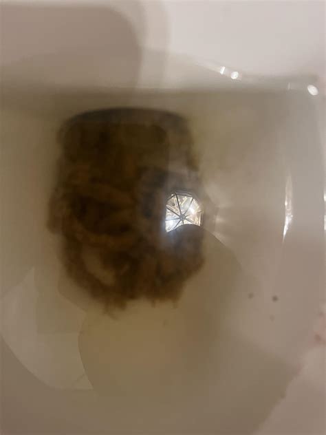 I have crohns and since I started stelara I’ve had pencil thin stools like this should i be a ...