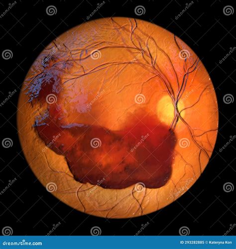 Vitreous Hemorrhage As Observed during Ophthalmoscopy, 3D Illustration Stock Illustration ...
