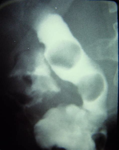 Biliary Stones 1565 Common Bile Duct Stones 6 | Surgery Photos