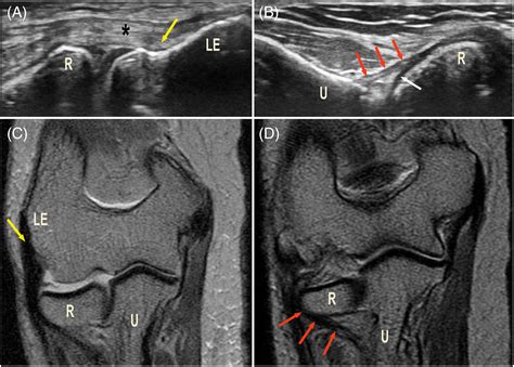 The lateral ulnar collateral ligament: Anatomical and structural study ...