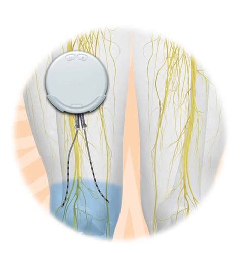 Peripheral Nerve Stimulation (PNS) Procedure in Minnesota