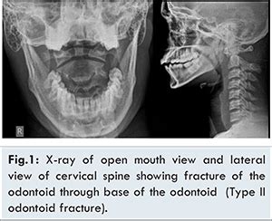 Anterior Odontoid Screw Fixation for Type II Odontoid Fracture ...