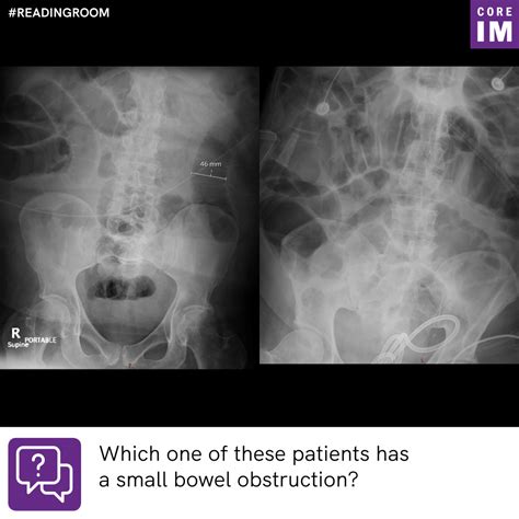 Bowel Gas Patterns | Core IM Podcast