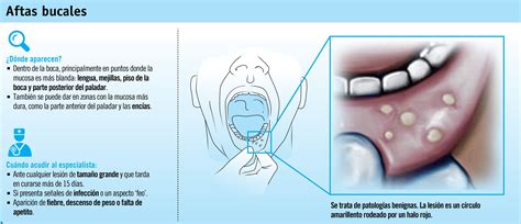 Las Causas De Las Aftas En La Lengua