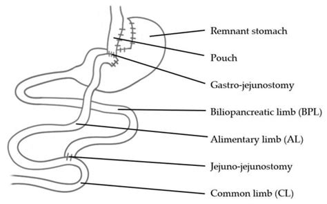 Bariatric Surgery–How Much Malabsorption Do We Need?—A Review of ...