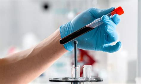 Right to Safe Blood: Supreme Court seeks NAT test cost, availability in ...