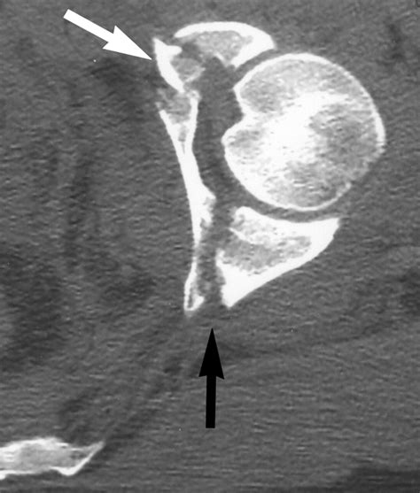 Acetabular Fractures Revisited: Part 2, A New CT-Based Classification | AJR