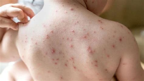 Monkeypox is more dangerous for children than adults | ಮಂಗನಕಾಯಿಲೆ ...