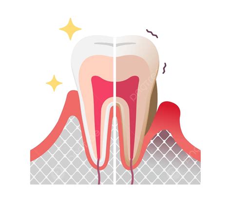 Flat Vector Illustration Comparing Healthy Teeth And Periodontal Disease Vector, Care, Dental ...