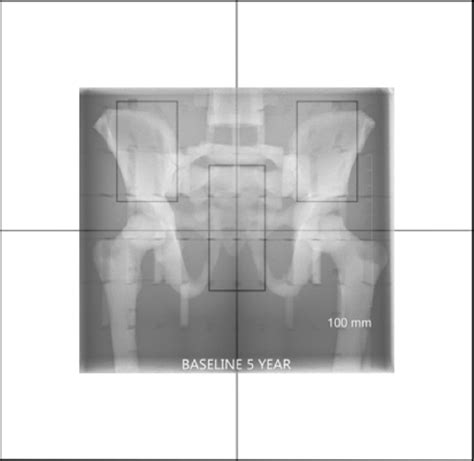 Figure 2 from An Investigation into the use of Automatic Exposure Control in Paediatric Direct ...
