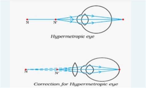 explain meaning causes correction of hypermetropia with ray diagrams ...