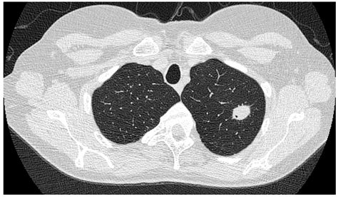 Chronic Pulmonary Aspergillosis—Where Are We? and Where Are We Going?