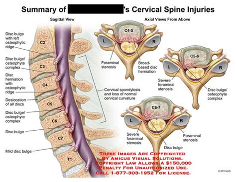 AMICUS Illustration of amicus,injury,cervical,spine,injuries,disc,bulge ...
