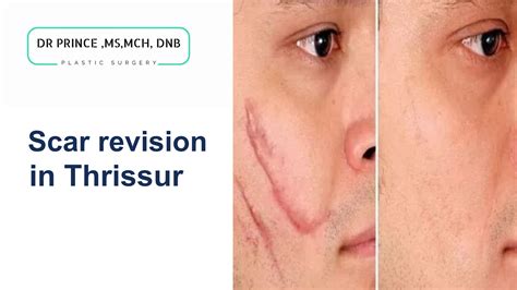 Types of Breast Implants in Kerala - topplasticsurgery