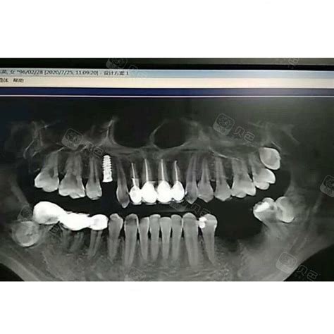 骨性三类，牙性一类，这点改善也挺难，高效反合解除，潘超正畸-南昌矫正牙医潘超的博客-KQ88口腔博客