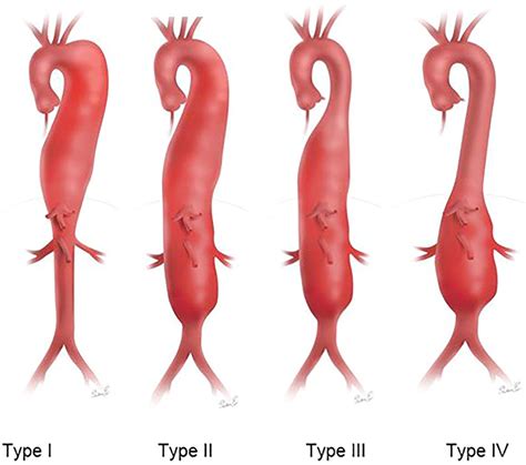 Thoracic Aortic Aneurysms and Arch Disease - Surgical Clinics