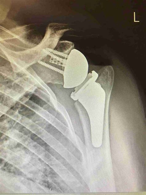 Rotator Cuff Surgery Versus Shoulder Replacement at Lula Wilson blog